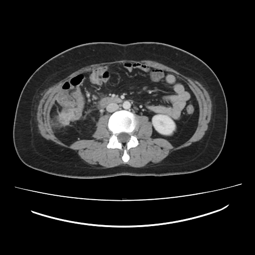 Ascending retrocecal appendicitis with liver abscesses (Radiopaedia 60066-67615 B 49).jpg