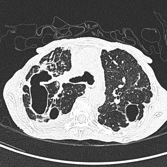 Aspergilloma- with Monod sign (Radiopaedia 44737-48532 Axial lung window 94).jpg