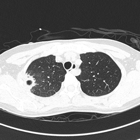 File:Aspergilloma (Radiopaedia 26223-26347 Axial lung window 18).jpg