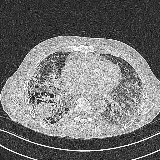 File:Aspergilloma on background pulmonary fibrosis (Radiopaedia 60942-68757 B 31).jpg