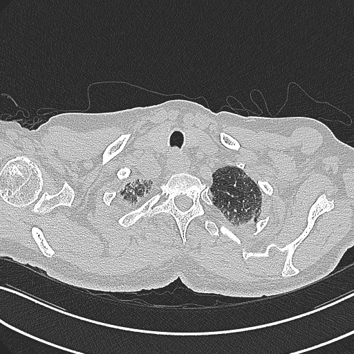 File:Aspergilloma on background pulmonary fibrosis (Radiopaedia 60942-68757 B 7).jpg