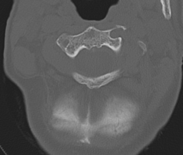 Atlanto-axial subluxation (Radiopaedia 36610-38176 Axial bone window 18).png