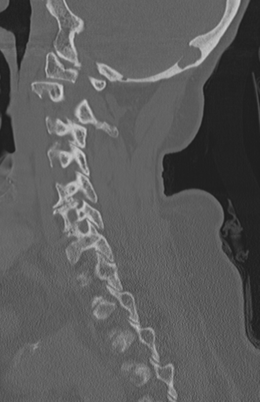 Atlanto-axial subluxation (Radiopaedia 36610-38176 Sagittal bone window 33).png