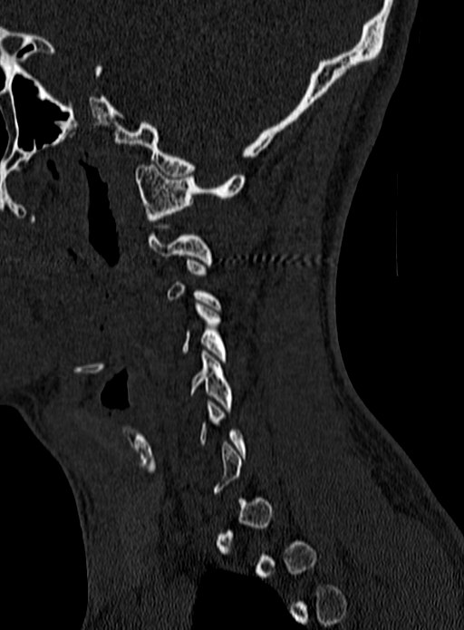 Atlantoaxial subluxation (Radiopaedia 44681-48450 Sagittal bone window 2).jpg