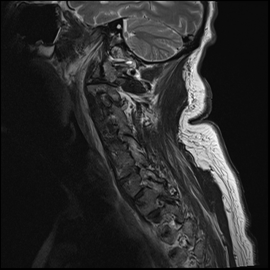 File:Atlas (type 3b subtype 1) and axis (Anderson and D'Alonzo type 3, Roy-Camille type 2) fractures (Radiopaedia 88043-104610 Sagittal T2 11).jpg