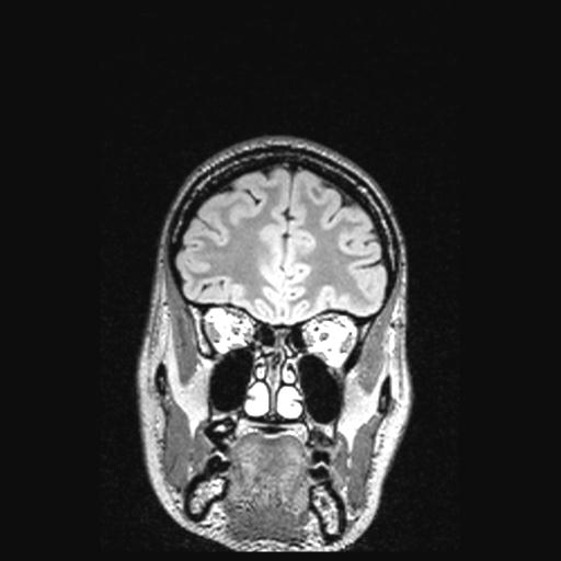Atretic encephalocoele with inferior vermis hypoplasia (Radiopaedia 30443-31108 Coronal FLAIR 143).jpg