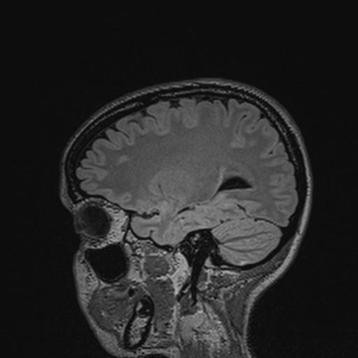 Atretic encephalocoele with inferior vermis hypoplasia (Radiopaedia 30443-31108 Sagittal FLAIR 55).jpg