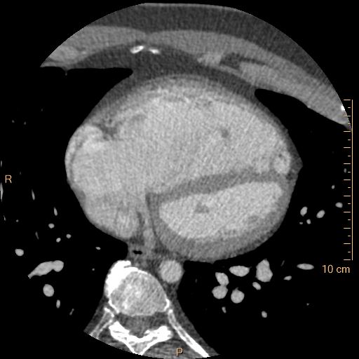 Atrial septal defect (upper sinus venosus type) with partial anomalous pulmonary venous return into superior vena cava (Radiopaedia 73228-83961 A 183).jpg
