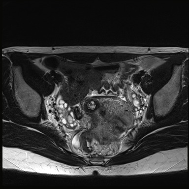 File:Atypical deep infiltrating endometriosis (Radiopaedia 44470-48125 Axial T2 15).jpg