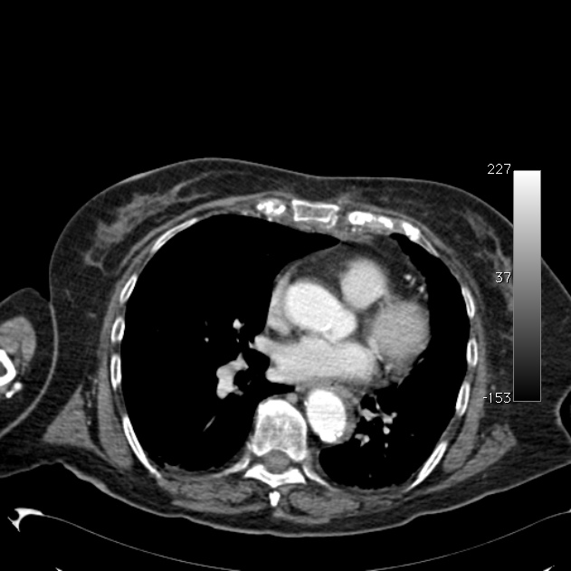 Atypical dissection of the thoracic aorta (Radiopaedia 10975-11393 A 43).jpg