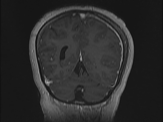 Atypical meningioma (Radiopaedia 62985-71406 Coronal T1 C+ 102).jpg