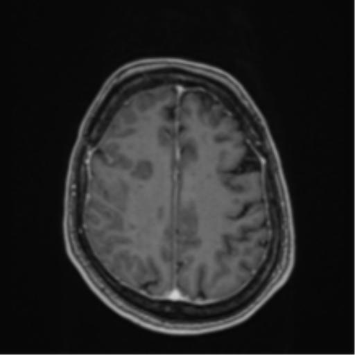 Atypical meningioma (WHO Grade II) (Radiopaedia 54742-60979 Axial T1 C+ 49).png