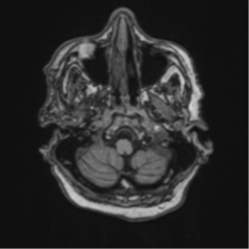 Atypical meningioma (WHO Grade II) (Radiopaedia 54742-60981 Axial T1 9).png