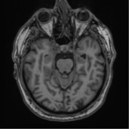 File:Atypical meningioma (WHO grade II) with brain invasion (Radiopaedia 57767-64729 Axial T1 17).png