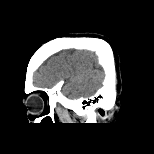 Atypical meningioma with skull invasion (Radiopaedia 34357-35649 E 9).png