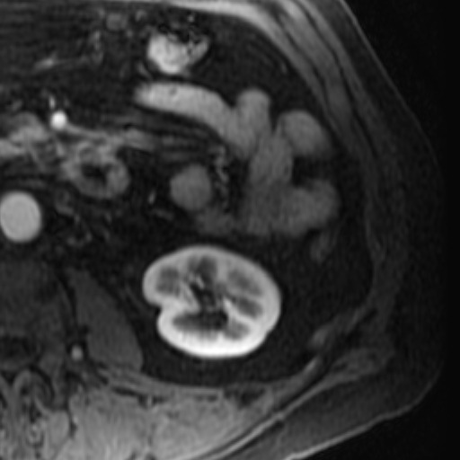 File:Atypical renal cyst on MRI (Radiopaedia 17349-17046 C 22).jpg