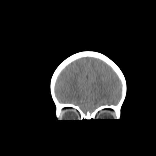 Atypical teratoid rhabdoid tumor (AT-RT) (Radiopaedia 85823-101654 Coronal non-contrast 8).jpg