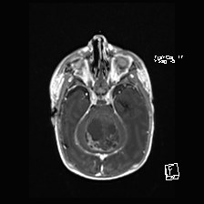 Atypical teratoid rhabdoid tumor (prenatal US and neonatal MRI) (Radiopaedia 59091-66388 Axial T1 C+ 20).jpg