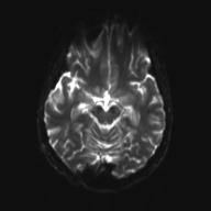 Autoimmune limbic encephalitis (Radiopaedia 30363-31005 Axial B0 and DWI 14).jpg