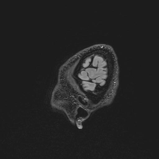 File:Autoimmune limbic encephalitis (Radiopaedia 30363-31005 Sagittal FLAIR 144).jpg