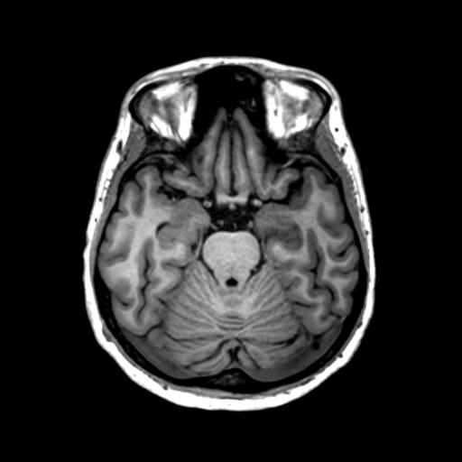 Autoimmune limbic encephalitis (Radiopaedia 30363-31005 T1 Axial 1mm 56).jpg