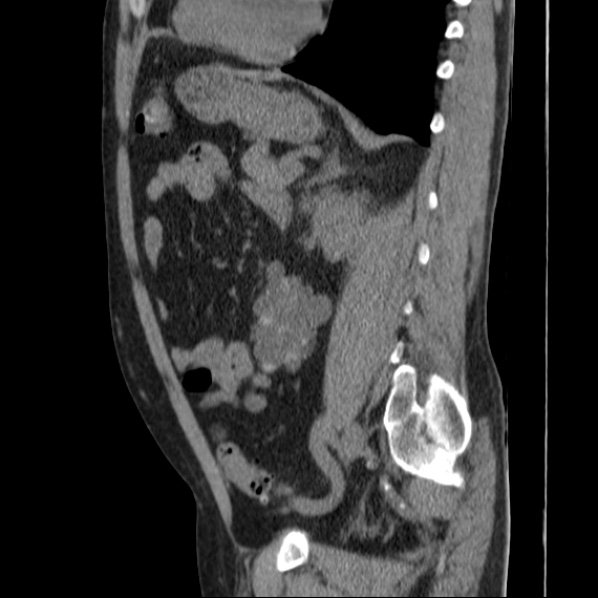 Autosomal dominant polycystic kidney disease (Radiopaedia 36539-38101 D 53).jpg