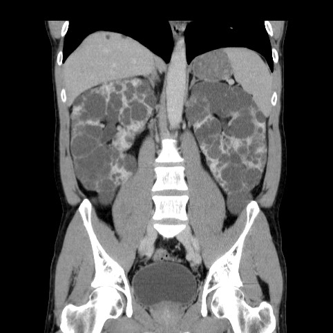 Autosomal dominant polycystic kidney disease (Radiopaedia 66349-75582 A 50).jpg