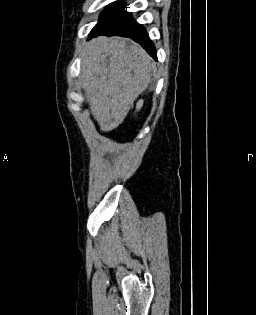 Autosomal dominant polycystic kidney disease (Radiopaedia 87830-104287 C 5).jpg
