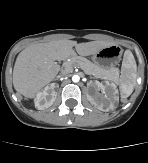 Autosomal dominant polycystic kidney disease - early onset (Radiopaedia 40734-43387 B 12).jpg