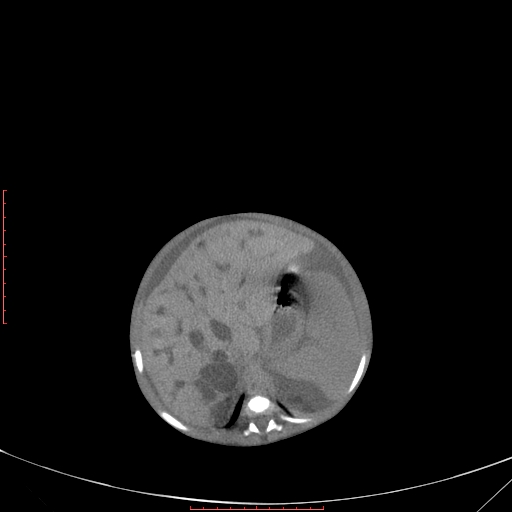 Autosomal recessive polycystic kidney disease associated with Caroli disease (Radiopaedia 61932-69984 Axial non-contrast 133).jpg