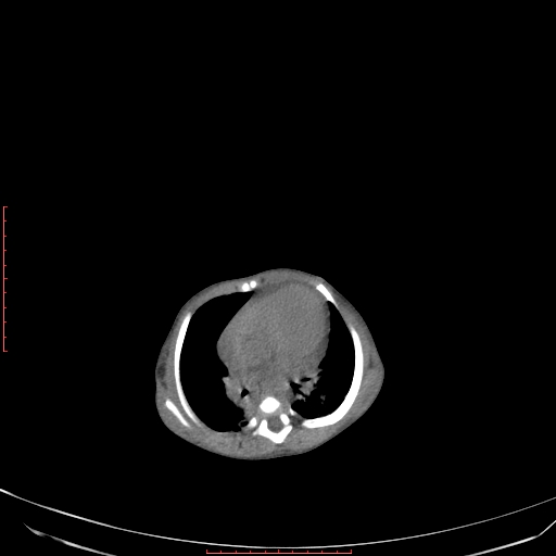 Autosomal recessive polycystic kidney disease associated with Caroli disease (Radiopaedia 61932-69984 Axial non-contrast 59).jpg