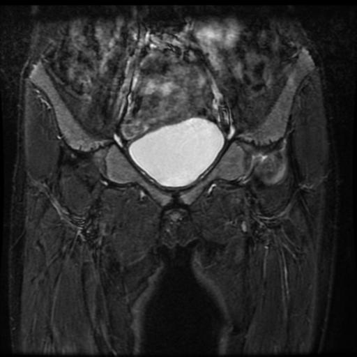 File:Avascular necrosis of the hip (Radiopaedia 29563-30067 Coronal T2 fat sat 3).jpg