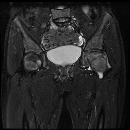 File:Avascular necrosis of the hip (Radiopaedia 29563-30067 Coronal T2 fat sat 6).jpg