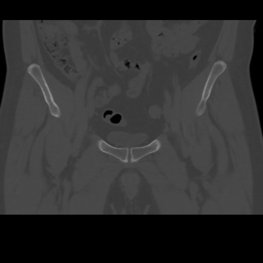 File:Avascular necrosis of the hip (Radiopaedia 61503-69467 Coronal bone window 5).jpg