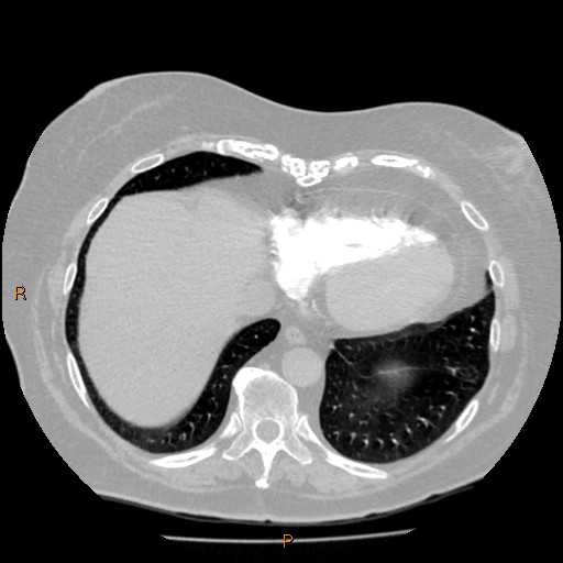 Azygos lobe (Radiopaedia 40161-42821 Axial lung window 59).jpg