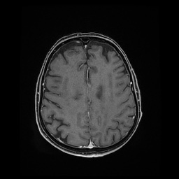 Balo concentric sclerosis (Radiopaedia 53875-59982 Axial LAVA C+ 180).jpg