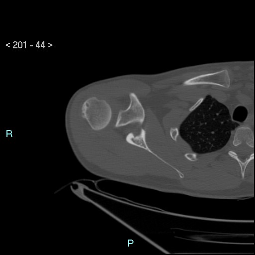 Bankart lesion with glenoid bone defect - assessment TC with PICO method (Radiopaedia 42855-93901 Axial bone window 43).jpg