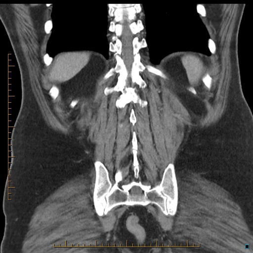 File:Bariatric balloon causing gastric outlet obstruction (Radiopaedia 54449-60672 B 49).jpg