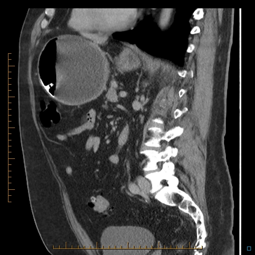 File:Bariatric balloon causing gastric outlet obstruction (Radiopaedia 54449-60672 C 36).jpg