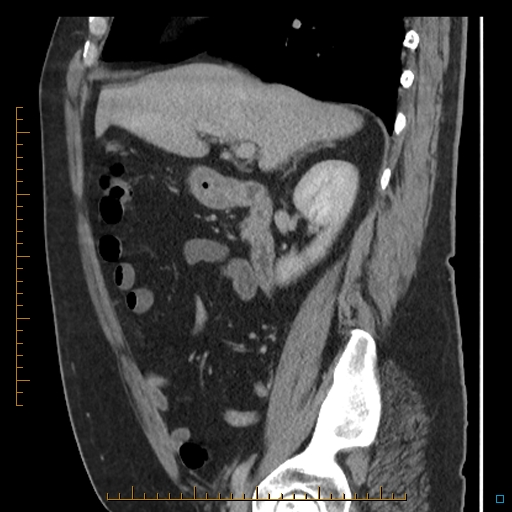 Bariatric balloon causing gastric outlet obstruction (Radiopaedia 54449-60672 C 53).jpg