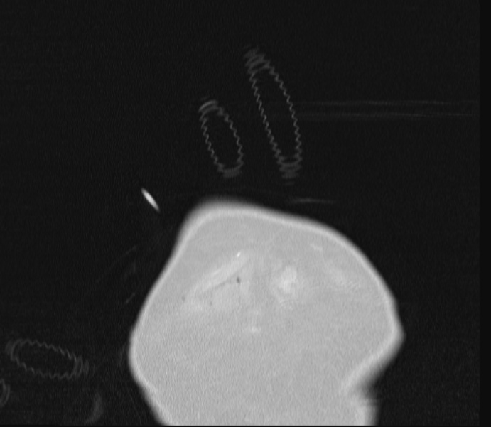 Barotrauma due to mechanical ventilation (Radiopaedia 28079-28336 Coronal lung window 3).jpg