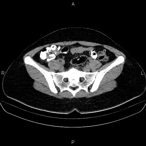 Bartholin gland cyst (Radiopaedia 62635-70930 Axial non-contrast 24).jpg
