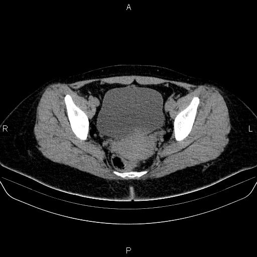 Bartholin gland cyst (Radiopaedia 62635-70930 Axial non-contrast 52).jpg