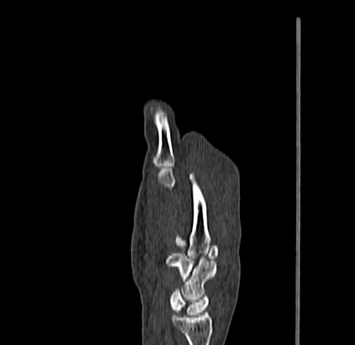Base of 2nd metacarpal fracture (Radiopaedia 73741-84544 Sagittal bone window 40).jpg