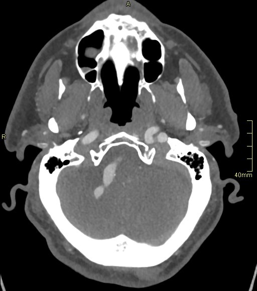 File:Basilar artery aneurysm (Radiopaedia 56261-62932 A 44).jpg