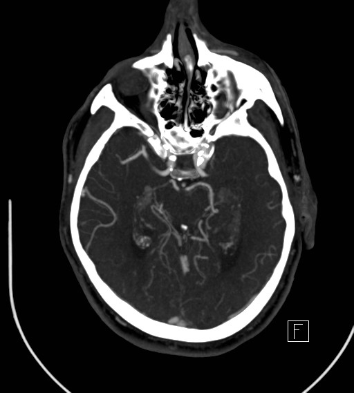 Basilar artery thrombosis (Radiopaedia 26986-27163 A 39).jpg