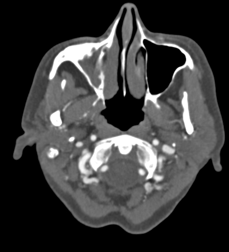 Basilar tip aneurysm with coiling (Radiopaedia 53912-60086 A 12).jpg