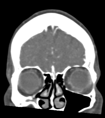 Basilar tip aneurysm with coiling (Radiopaedia 53912-60086 B 17).jpg