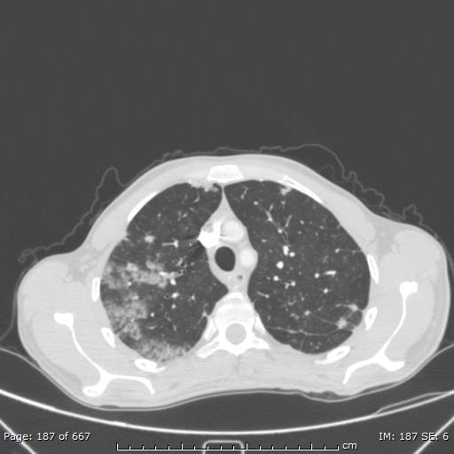 Behçet disease (Radiopaedia 44247-47889 Axial lung window 21).jpg