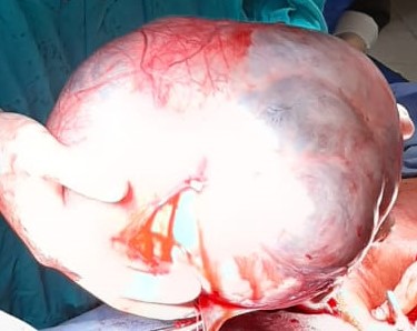 File:Benign seromucinous cystadenoma of the ovary (Radiopaedia 71065-81340 B 1).jpg